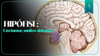 Tumor na hipófise: diagnóstico, sintomas e o que fazer após o exame de sangue.