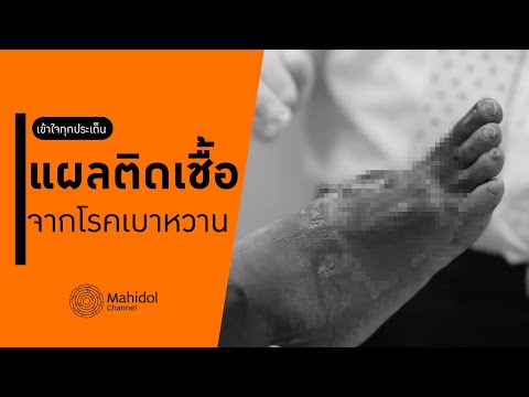 แผลติดเชื้อจากโรคเบาหวาน ส่งผลอะไรต่อร่างกายเราบ้าง? [หาหมอ by Mahidol Channel]