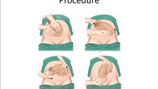 GYNAECOLOGY & OBSTETRICS - TOPIC - BREECH PART 2