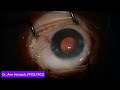 Cortical Proliferation post Lensectomy in an 8-month-old child