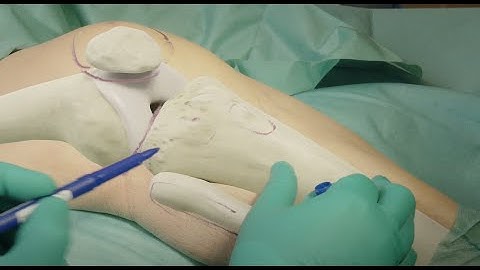 Tibial plateau fracture fixation with lateral locking plate preview