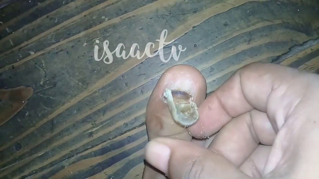 Toenail Removal Horrible Toenail Worst (Ugly Feet) NEW - YouTube