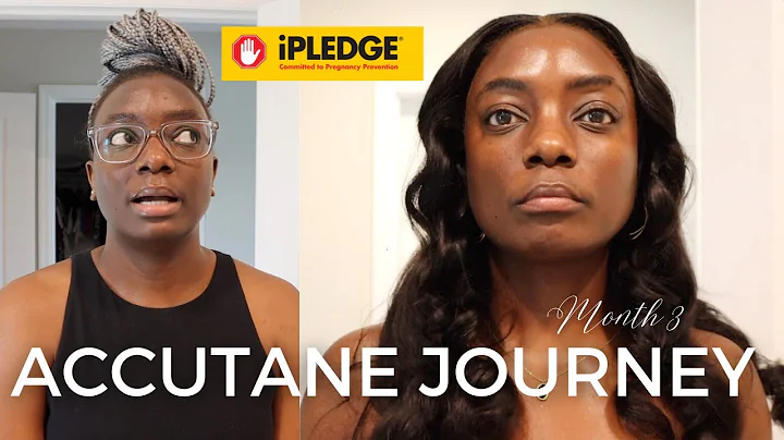 ACCUTANE JOURNEY MONTH 3 : iPLEDGE PROGRAM & MONTHLY QUIZ | SKIN BRITTLENESS | I CAN SEE THE LIGHT!