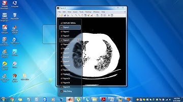 Lung cancer detection using matlab|ieee matlab projects at bangalore