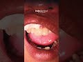 TAMBAL GIGI DEPAN PATAH oleh drg. Andrian Chandra #tambalgigi #gigipatah #dentist #sakitgigi