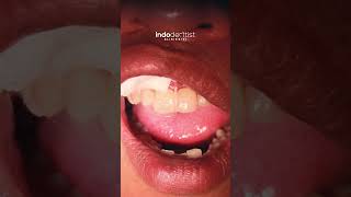 TAMBAL GIGI DEPAN PATAH oleh drg. Andrian Chandra #tambalgigi #gigipatah #dentist #sakitgigi