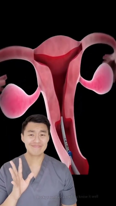 Cara pasang KB IUD, yang udah pasang sakit ga sih? #youtubehealth #dokter #shorts #kbiud