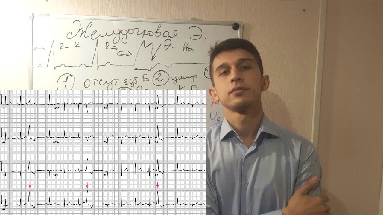 ЭКСТРАСИСТОЛИЯ НА ЭКГ:ЖЕЛУДОЧКОВАЯ,АТРИОВЕНТРИКУЛЯРНОЕ,ПРЕДСЕРДНАЯ ...