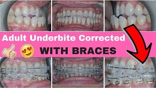 NO MORE UNDERBITE! ADULT UNDERBITE CORRECTED WITH BRACES AND M.E.A.W. TECHNIQUE WIRES