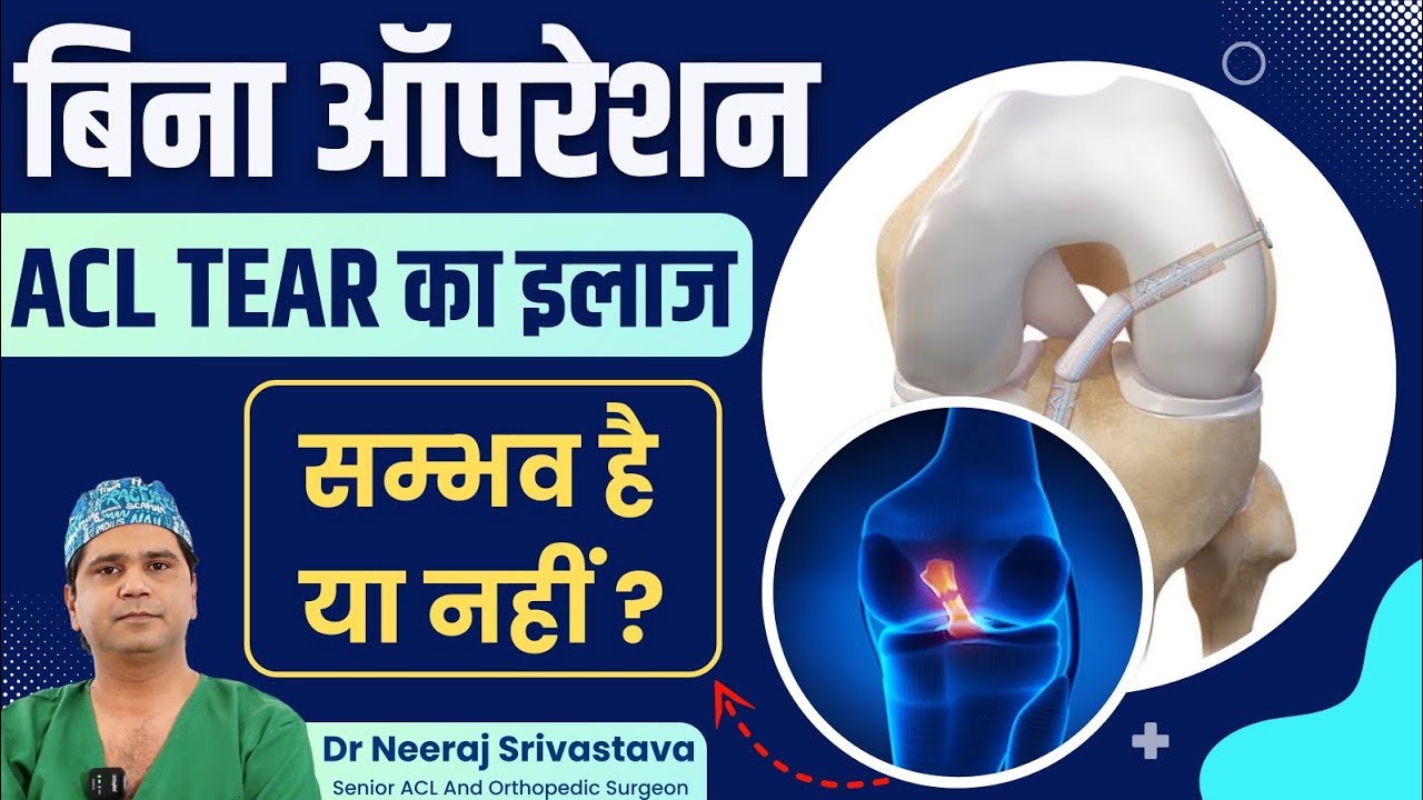 क्या बिना ऑपरेशन Acl Tear का इलाज हो सकता है? | Acl Treatment Without Surgery | Dr Neeraj Srivastava