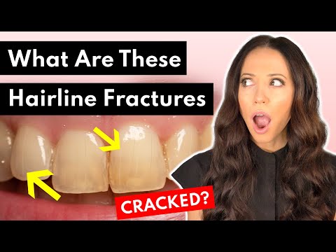 What Are Craze Lines On Teeth x What To Do About Them