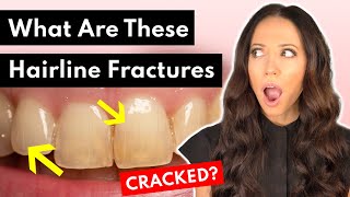 What are CRAZE LINES on Teeth & What to Do About Them