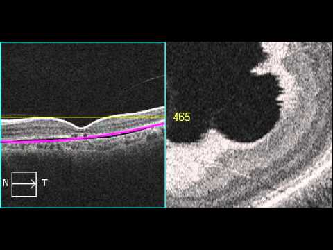 cone dystrophy