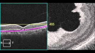 Cone Dystrophy Advanced Vis Bw Os