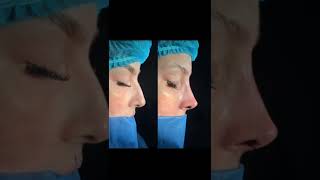 Rinoplastia primaria Dr Luis Jaimes 06/06/26