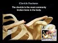 Clavicle Fractures  - Everything You Need To Know - Dr. Nabil Ebraheim