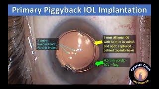 primary piggyback IOL implantation at time of cataract surgery