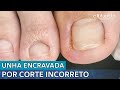 UNHA ENCRAVADA POR CORTE INCORRETO