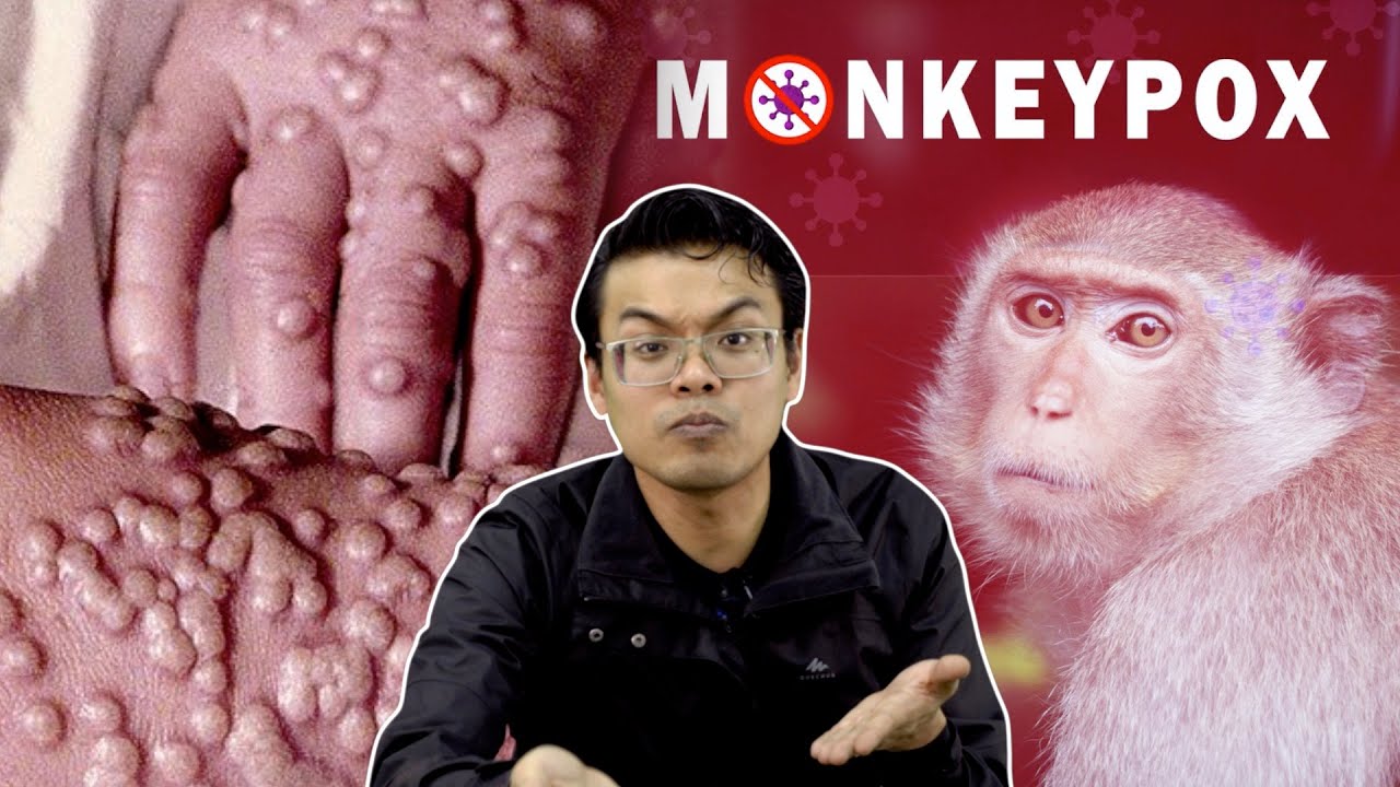Jangan Bagi Monkeypox Masuk Malaysia