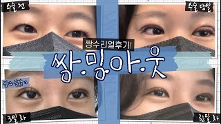 [쌍꺼풀수술 직후 VLOG] 중꺾마 무쌍의 쌍수 브이로그 (#자연유착  #인아웃라인 #셀프실밥제거)