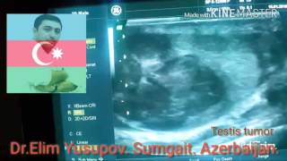 Testis tumor.  Seminoma. Рак яичка.  Семинома(, 2016-01-20T18:15:25.000Z)