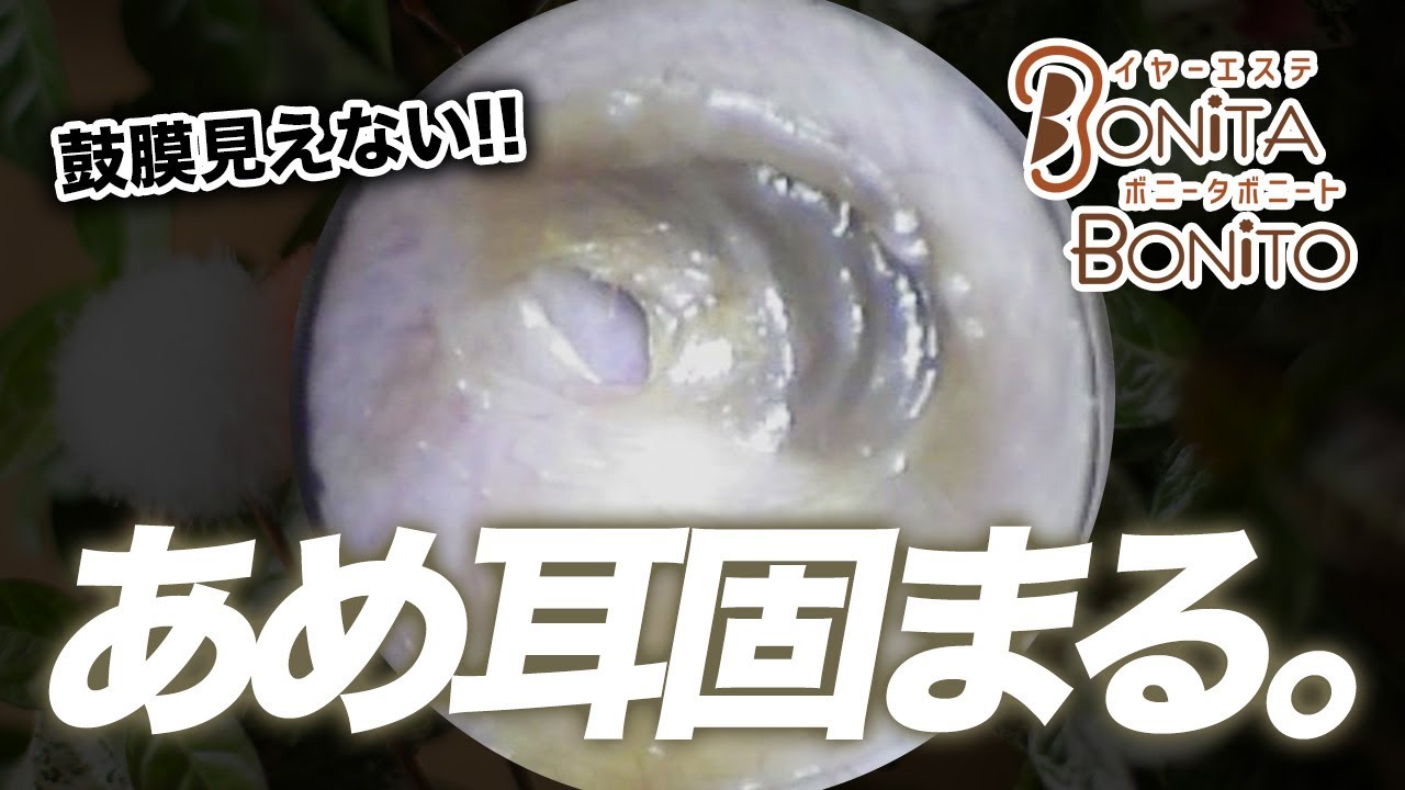 @ボニータボニート耳かきチャンネル【#耳掃除】あめ耳固まる!鼓膜見えない。。
