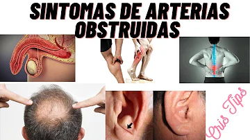 ¿Cómo se siente si su arteria está obstruida?