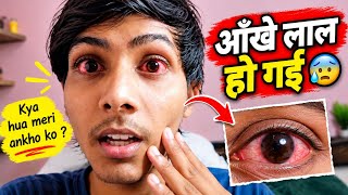 Red eyes👁️😰😱