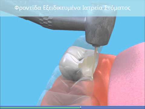 Ένθετο