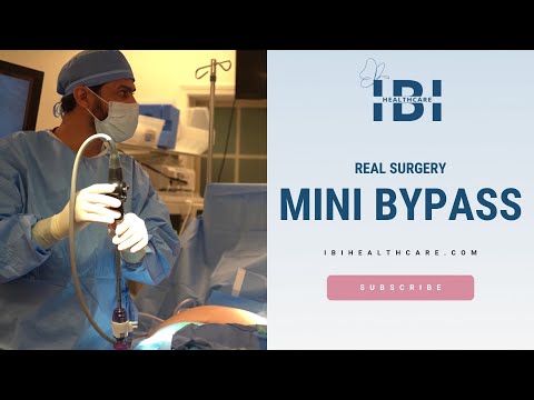 Real Surgery - Mini Gastric Bypass - IBI Healthcare Institute