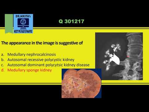 IVP-PAINT BRUSH /BOUQUET OF FLOWERS | Medullary sponge kidney disease