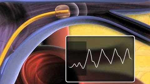 Swan-Ganz Thermodilution Pulmonary Artery Catheter