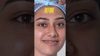 Jaw Surgery for a pretty girl - Before and After