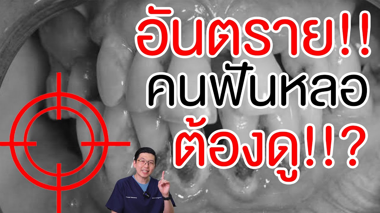 ฟันหลออันตรายแค่ไหน ?  | คลายปัญหาฟันกับหมอโชค