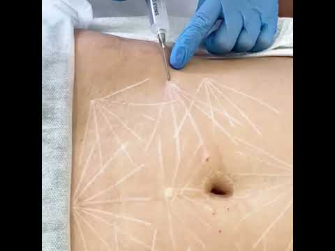 Инъекции Sculptra для омоложения кожи живота