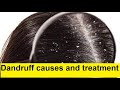 Dandruff causes and treatment