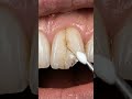 Starts with the exact search phrases people use (“Cracked Front Tooth Repair “Chipped Front Tooth”)