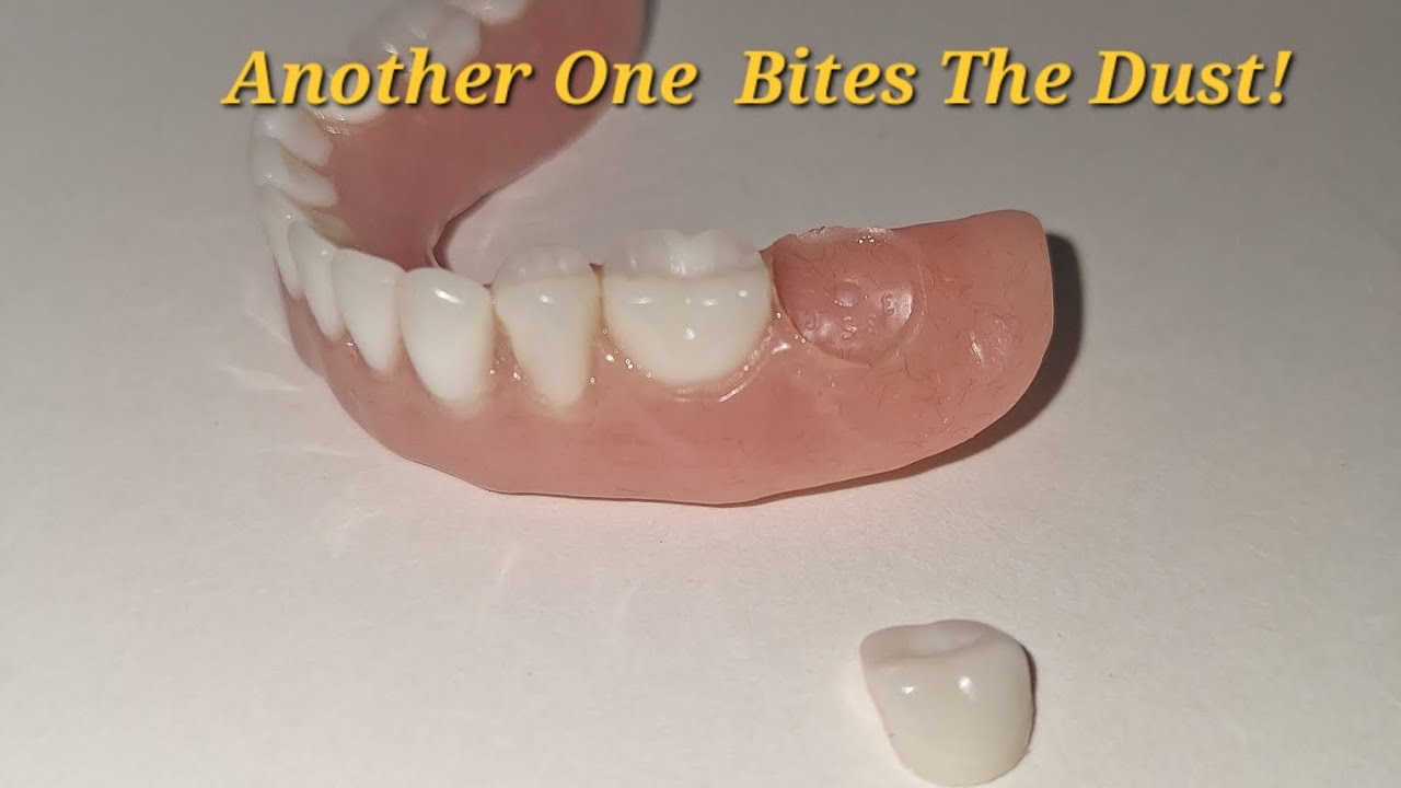 Aspen Dental 6th Denture tooth Failure in 15 Months dentures 