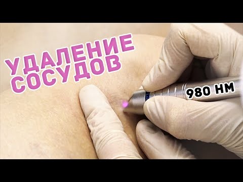 Курс обучения - Удаление сосудов диодным лазером 980 нм.