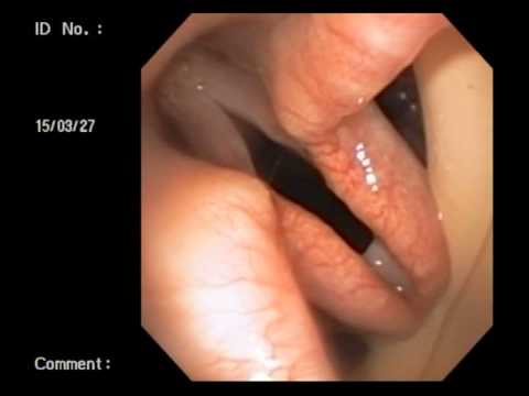 Veterinary Bronchoscopy#452, Laryngeal Paralysis Standard Poodle 11y
