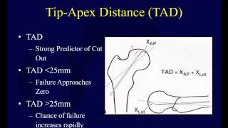 Proximal Femur Fractures 4  Intertrochanteric Hip Fractures