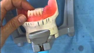 Montage des dents prothétiques en PAC: Partie 2, Le montage antérieur