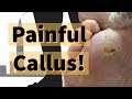 Painful Corns and Calluses: Foot Care For The Elderly