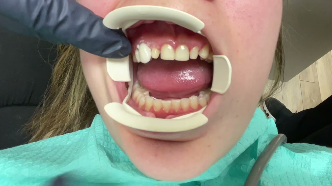 Houston Cosmetic Dentist... Step by step placement of Minimal Prep