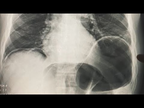 حالة طارئة تحتاج تدخل جراحي سريع لكن سهل تشخيصها بالاشعة هالفيديو يخلينا نتعلم تشخيصها سوا