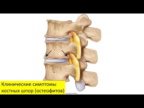 Клинические симптомы костных шпор (остеофитов) позвоночника