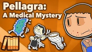 Pellagra  A Medical Mystery  Extra History