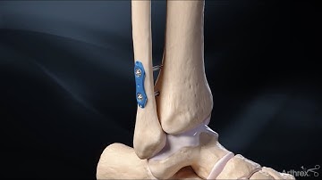 Arthrex Syndesmosis TightRope XP Implant System