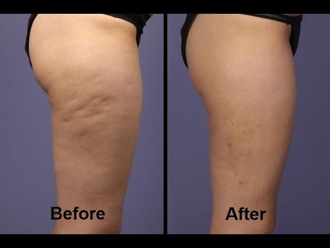 Fastest Way To Get Rid Of Cellulite Symulast Youtube