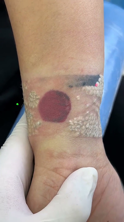 SCAR FREE TATTOO REMOVAL ep212 #short